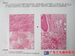 脑科肿瘤爆料案例最新,最新爆料揭示治疗挑战与希望 第3张 脑科肿瘤爆料案例最新,最新爆料揭示治疗挑战与希望 第3张